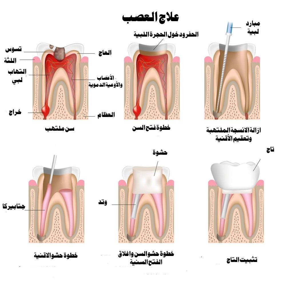 أنواع حشو عصب الضرس
