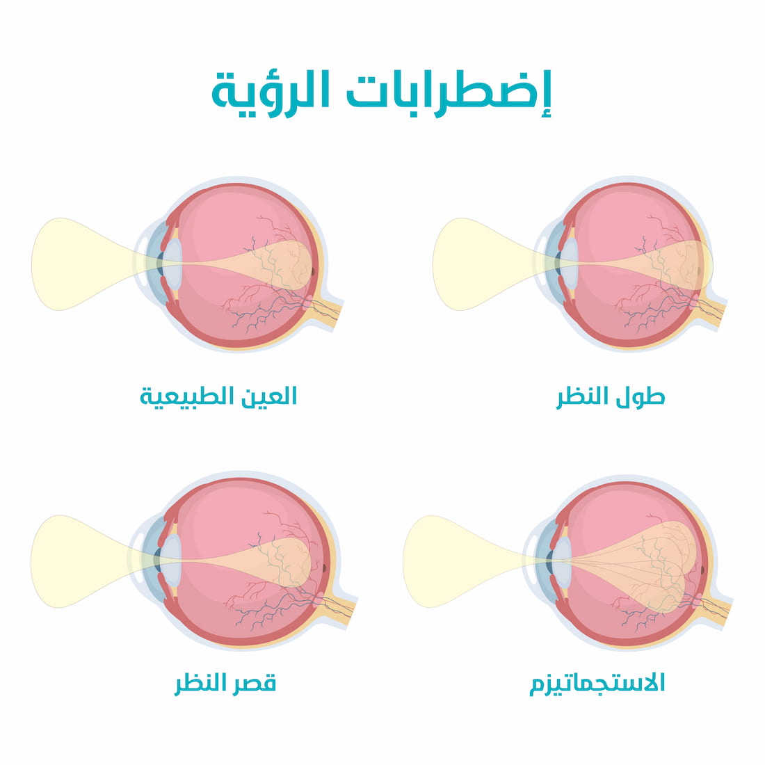 قصر النظر
