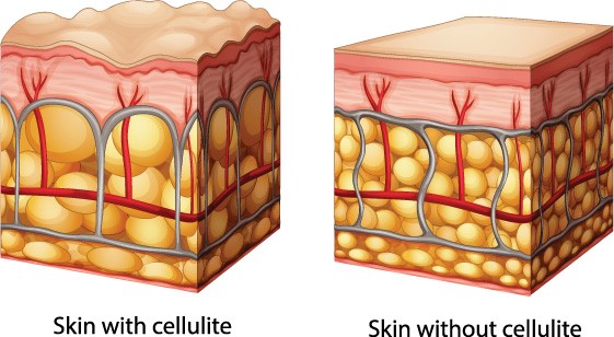 blood flow and cellulite