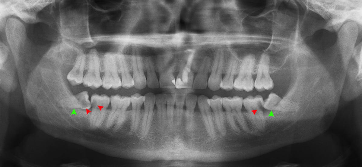wisdom teeth