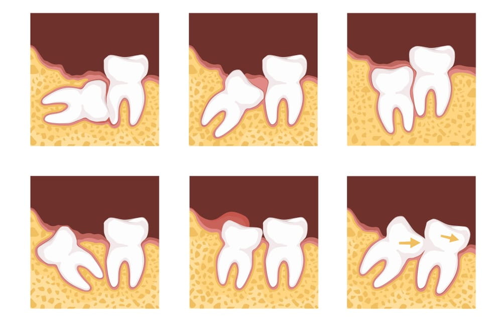 Lower Wisdom Teeth