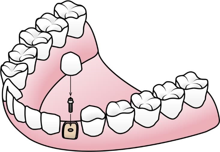 prix implant dentaire