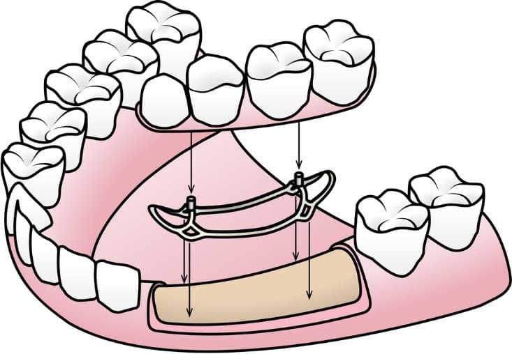 أنواع زراعة الأسنان واسعارها