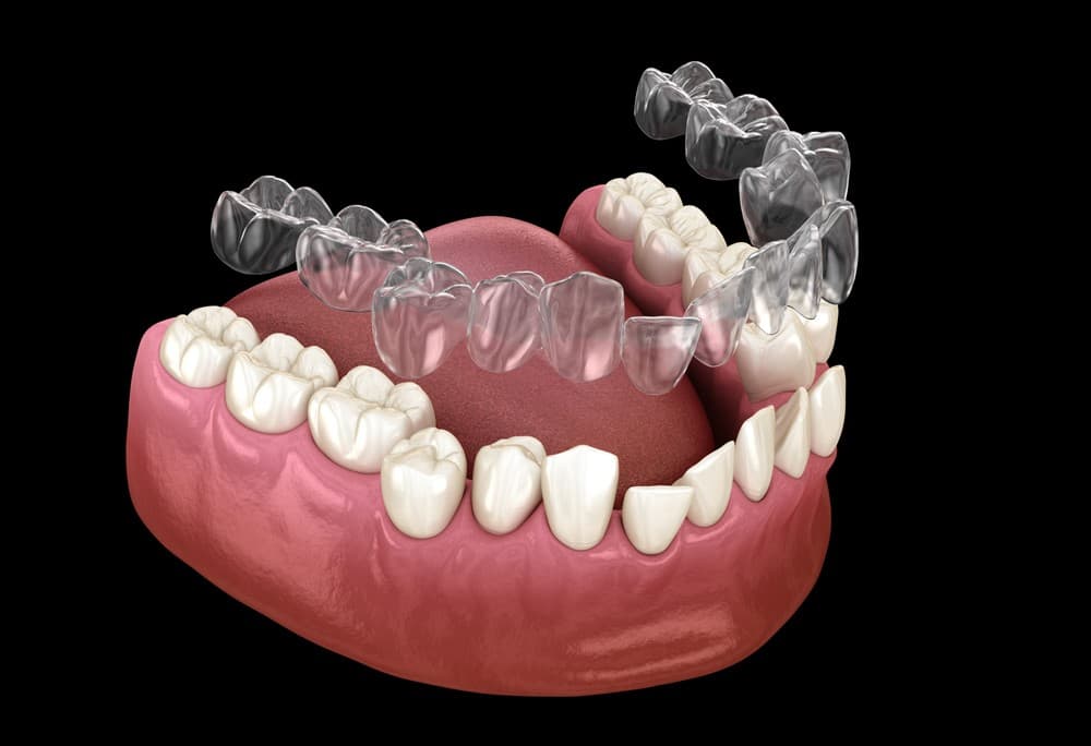 Les gouttières Invisalign® - Centre dentaire Lancy - Genève