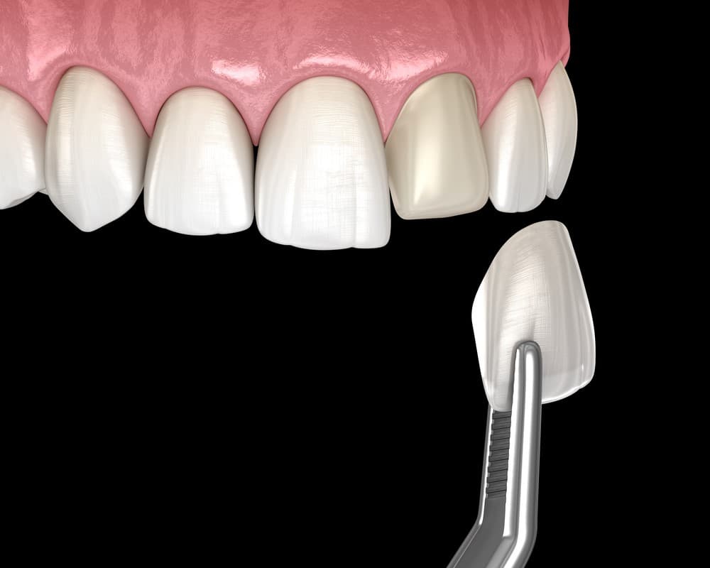 What is a Hollywood Smile?