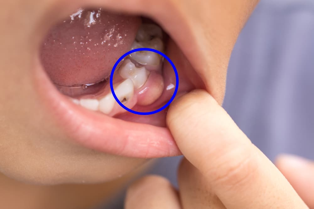 Tooth abscess pictures