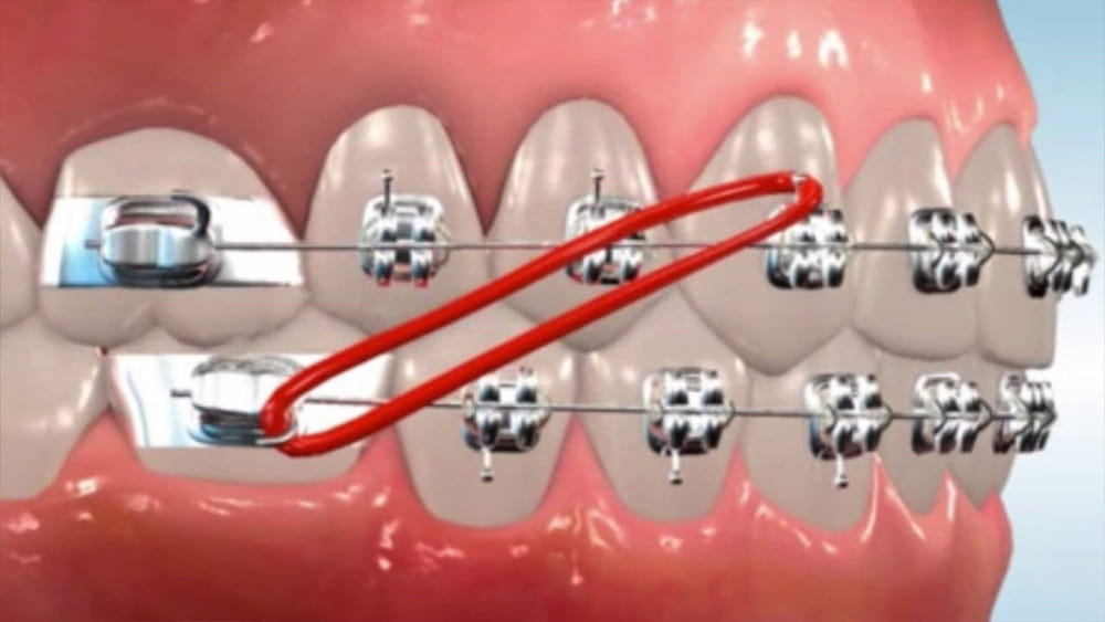 الربط المتقاطع في عملية ربط الأسنان للتنحيف