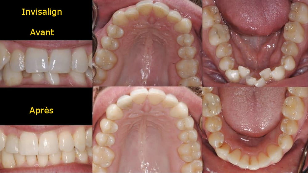 invisalign avant après