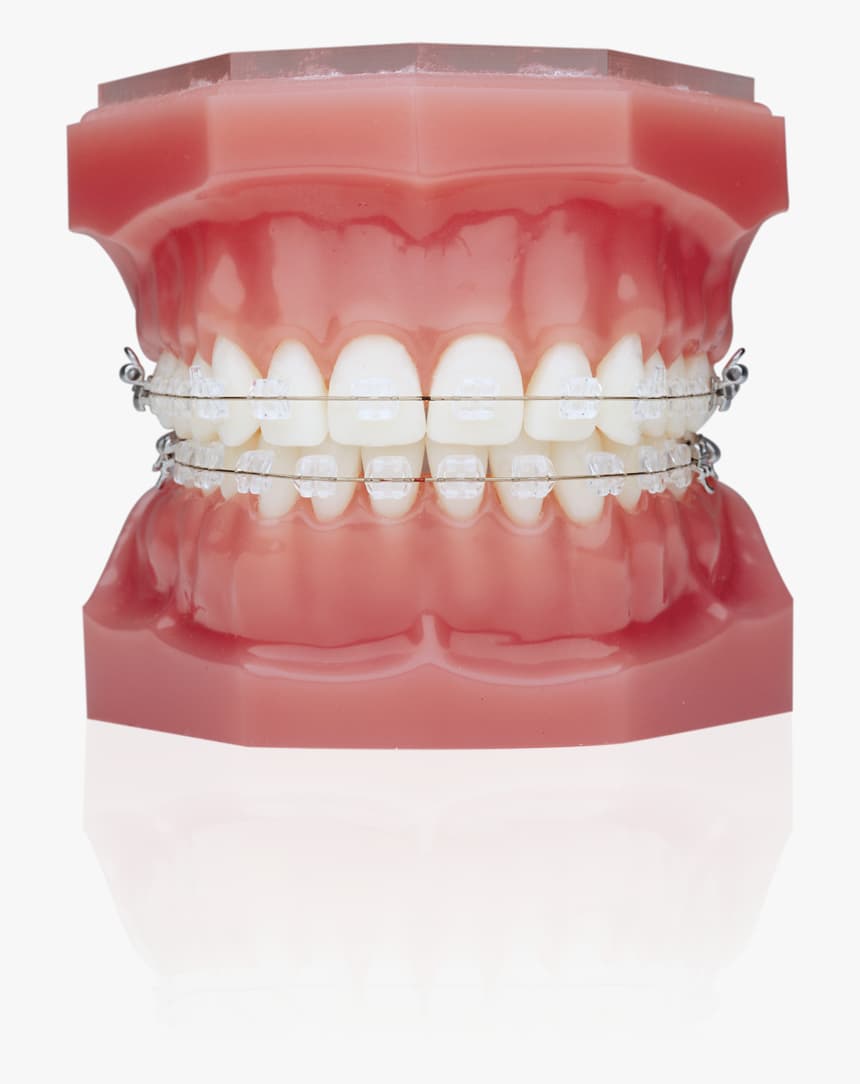 تقويم الاسنان المعدني البسيط