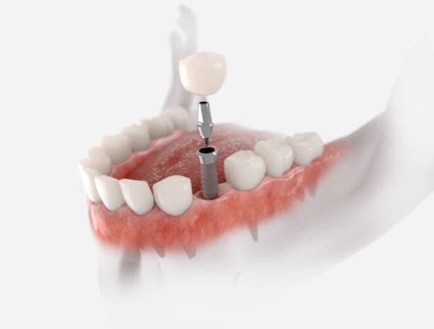 delayed dental implants