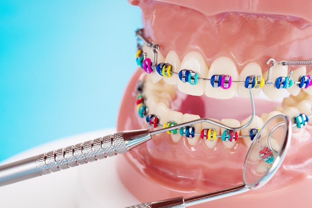 metal braces colors