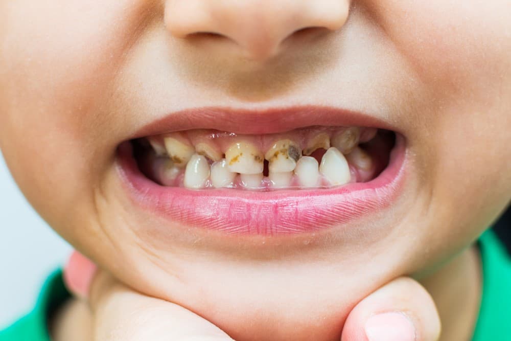 điều trị răng cửa bị sâu