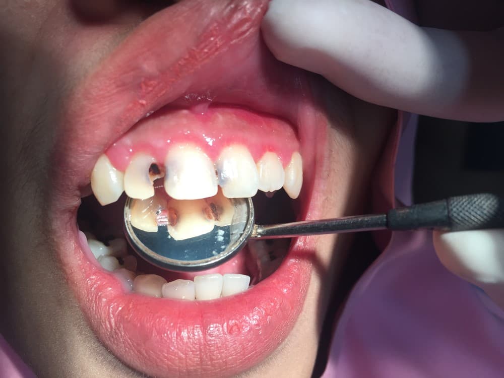 Front tooth deals cavity filling