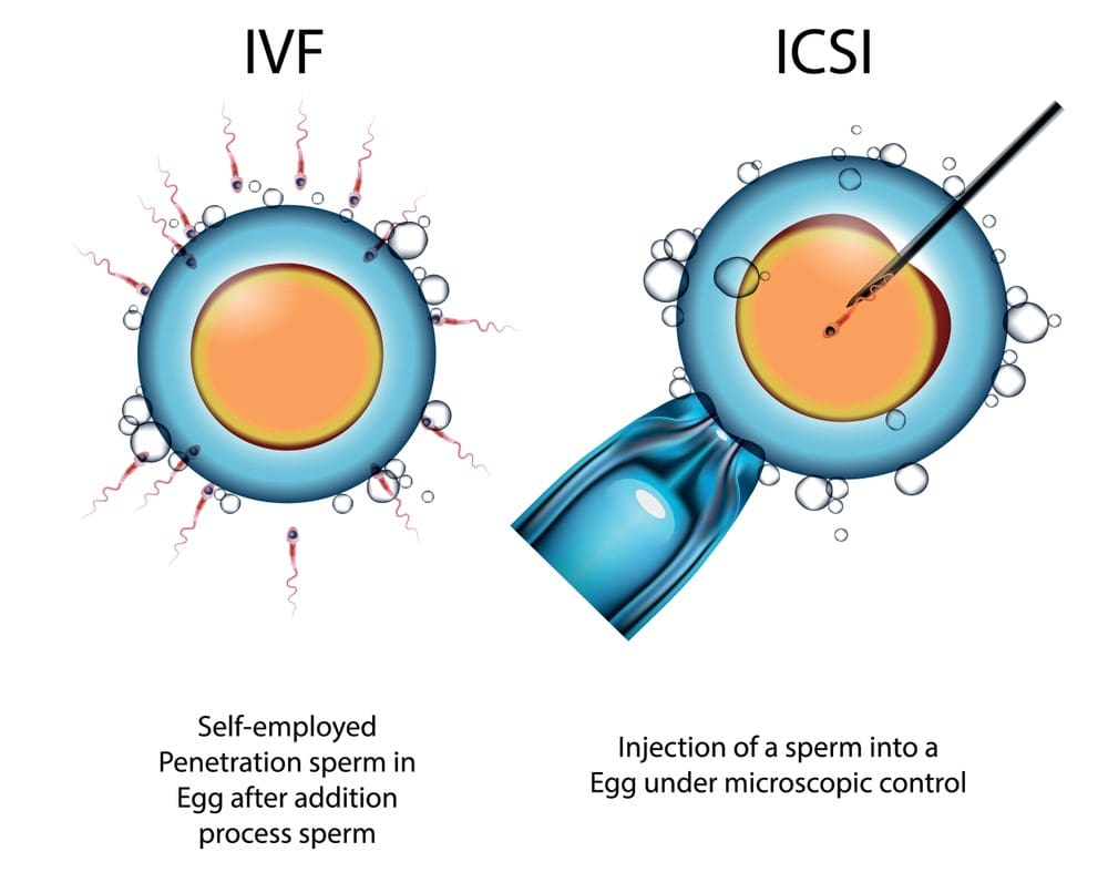 icsi vs ivf