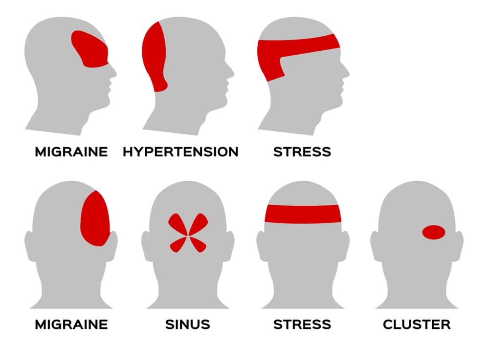 common types of headaches