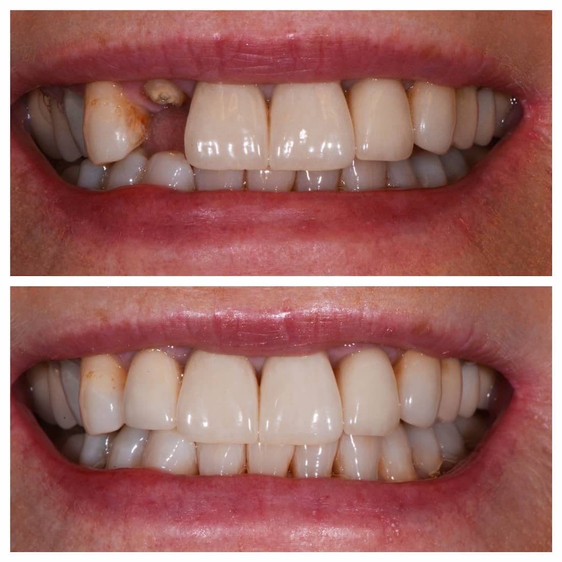 تجميل الاسنان قبل وبعد 1