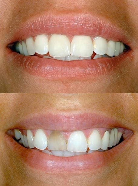 تجميل الاسنان قبل وبعد 3