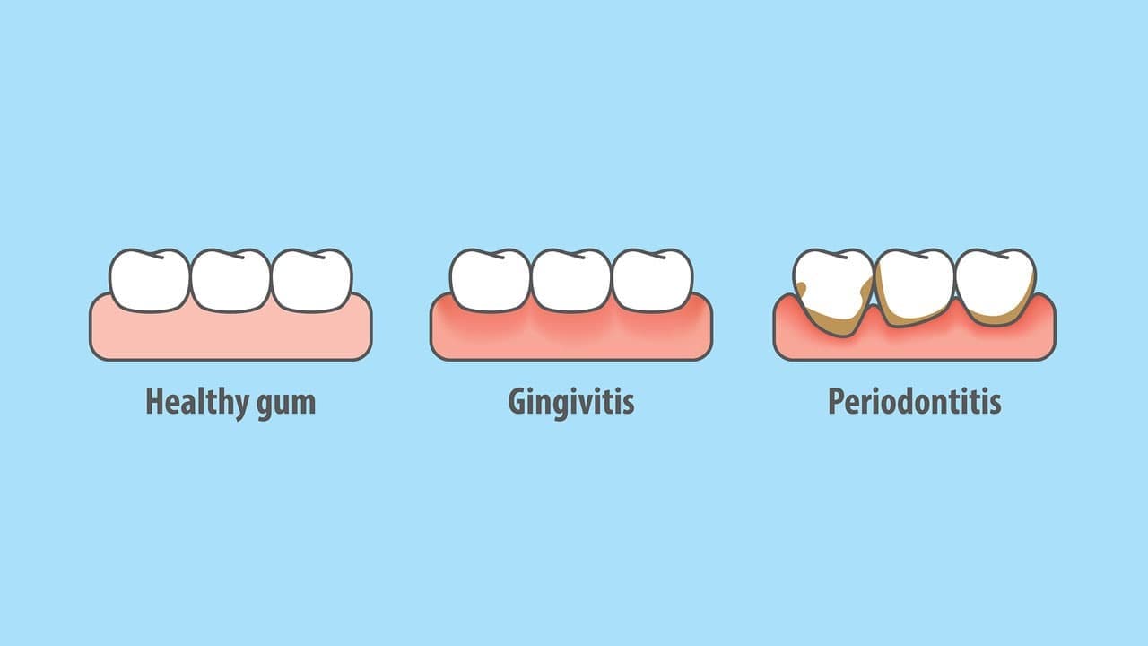 gingivitis vs periodontitis
