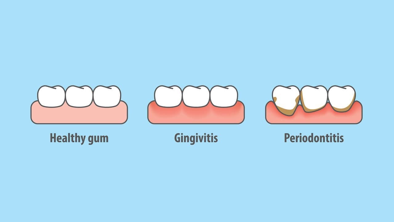 gingivitis vs periodontitis