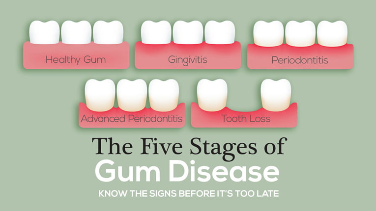 Gingivitis stages