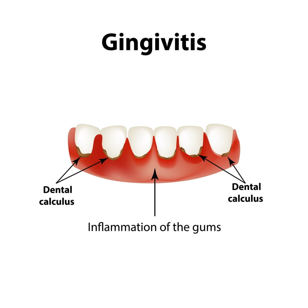 gingivitis pictures