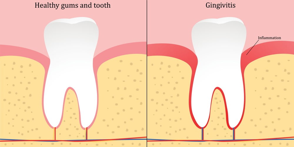 Healthy gums vs gingivitis