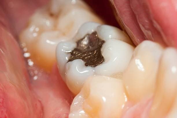 علاج حساسية الأسنان بعد الحشو