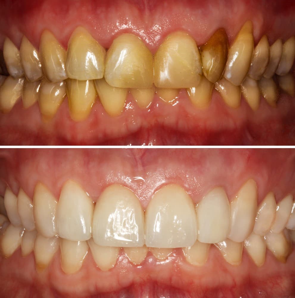 Yellow teeth before and after