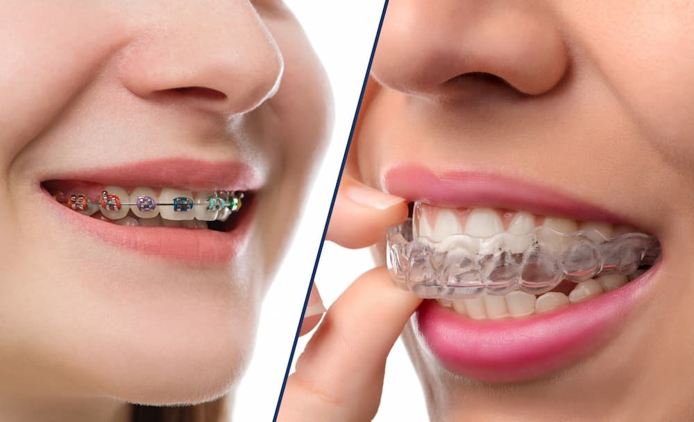 Appareil dentaire métal ou transparent