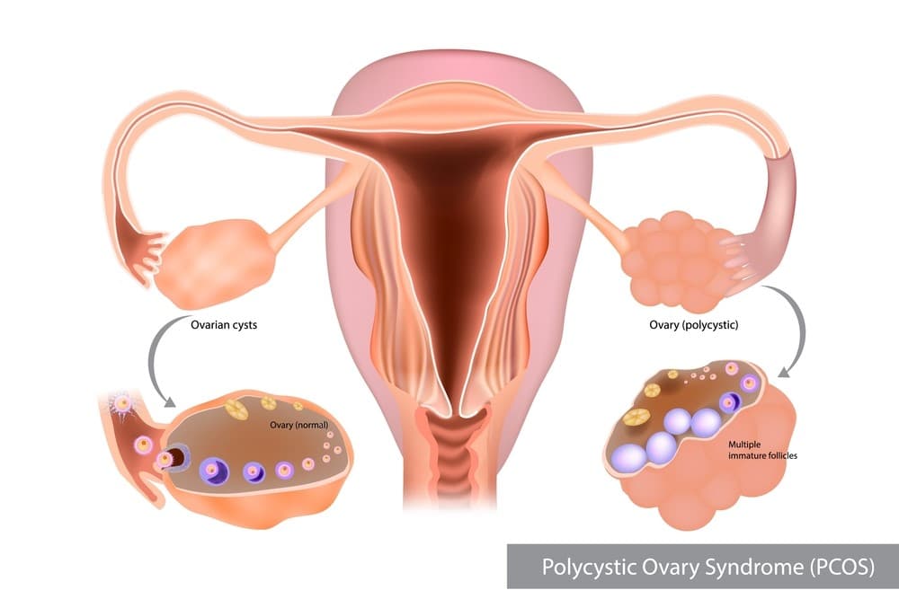 متلازمة المبيض المتعدد التكيسات