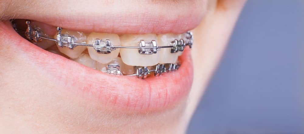 Orthodontics in Turkey