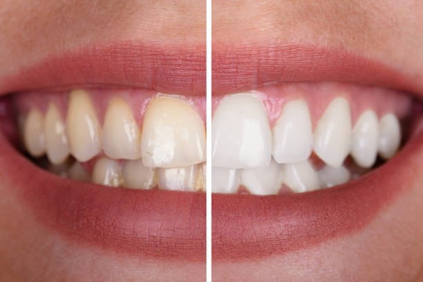 Teeth Whitening in Turkey