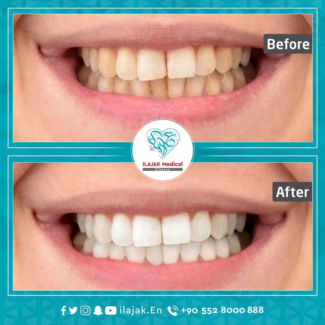 Hollywood Smile in Turkey before and after 2