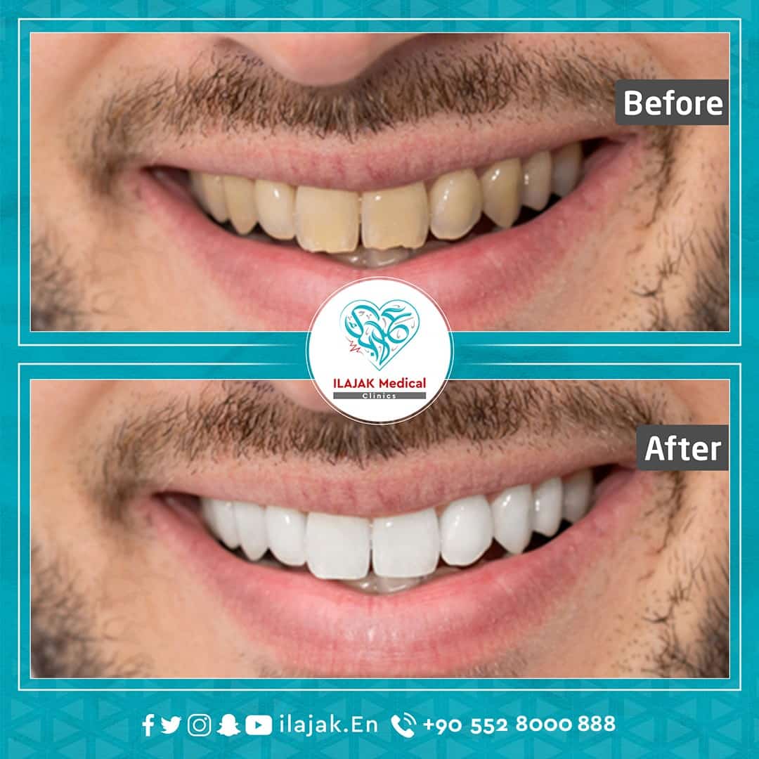 Hollywood Smile in Turkey before and after 3