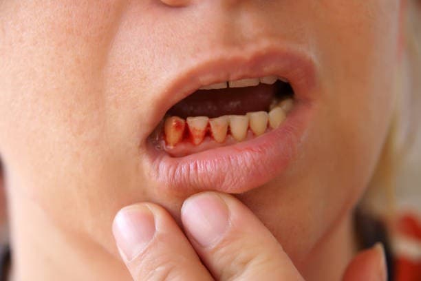 حالات الأسنان التي يمكن أن تسبب نزيف اللثة