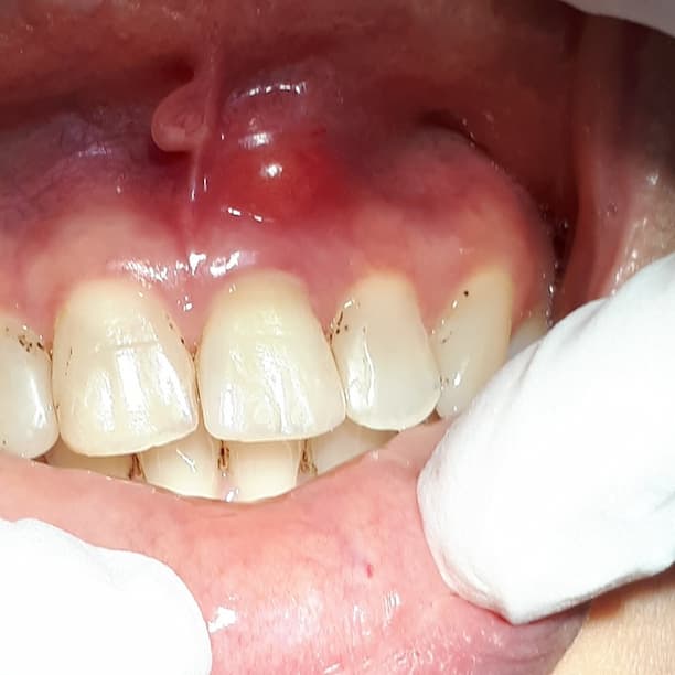 Tooth abscess pictures 1