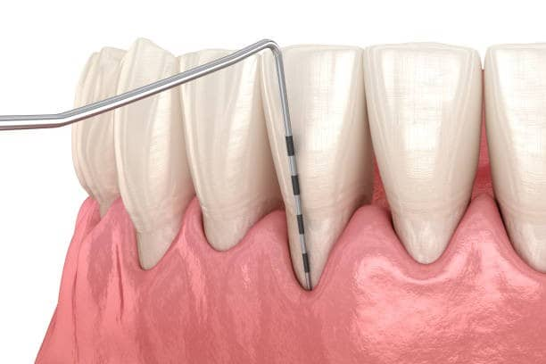 Diagnostic de la récession gingivale