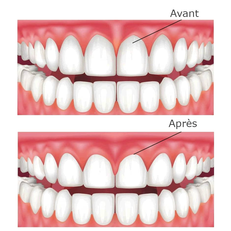 Greffe de gencive avant après