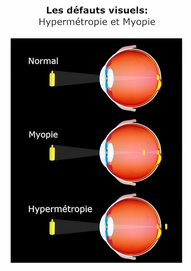 Des gouttes oculaires capables de corriger la réfraction