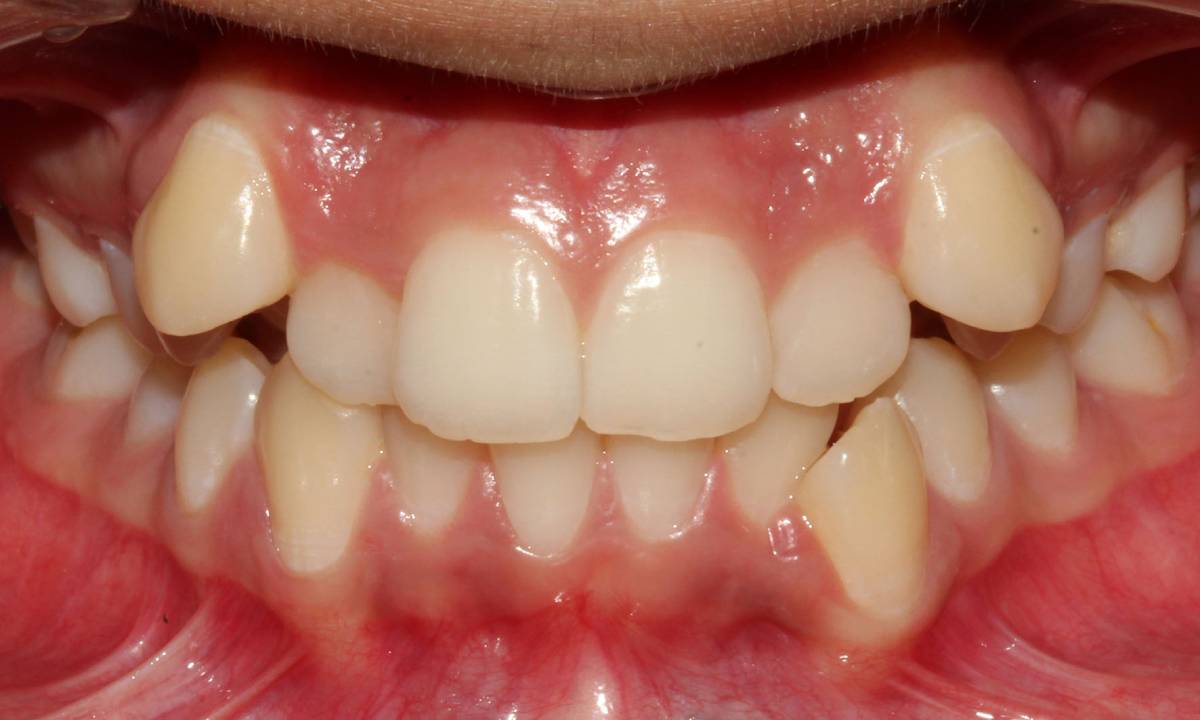 اعوجاج الاسنان