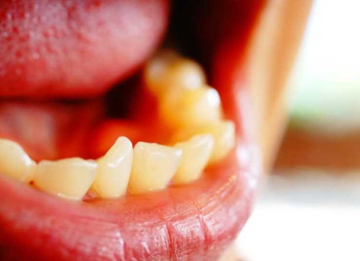اسباب اعوجاج الاسنان