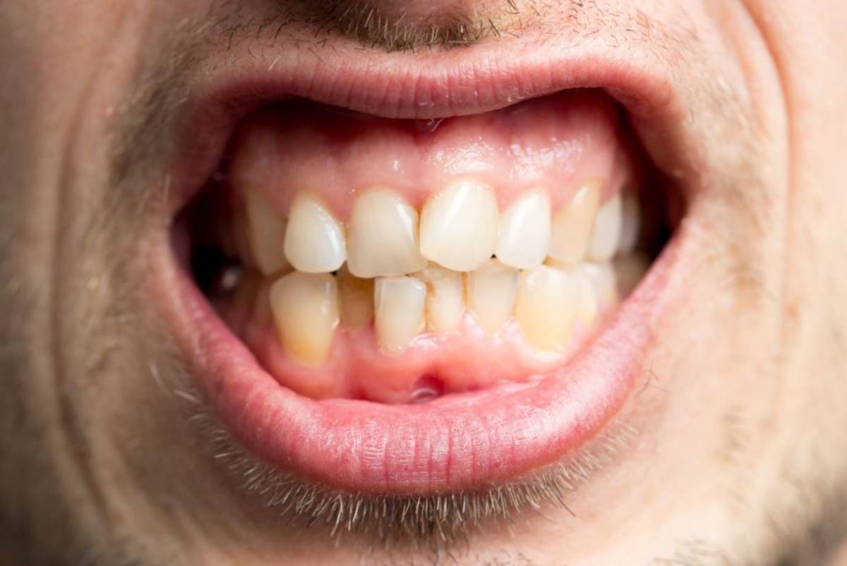 اعوجاج الاسنان، اعراض اعوجاج الاسنان
