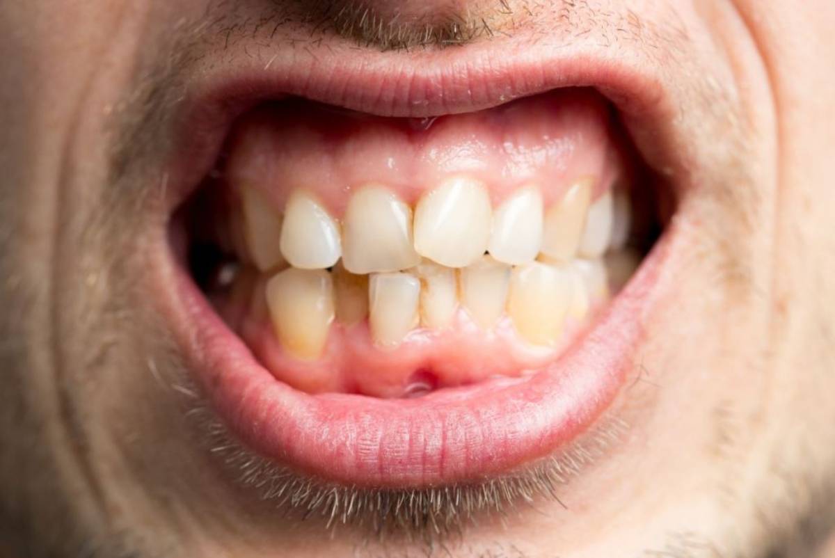 هل يمكن علاج اعوجاح الاسنان بدون تقويم