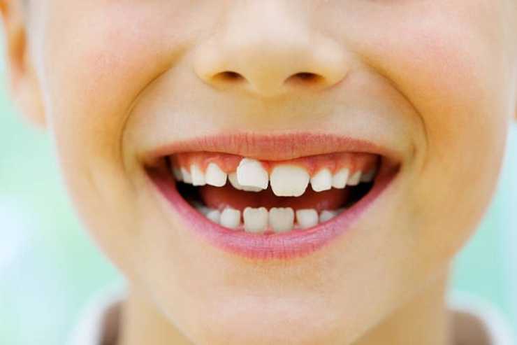 اعوجاج الاسنان، اعوجاج الاسنان عند الاطفال