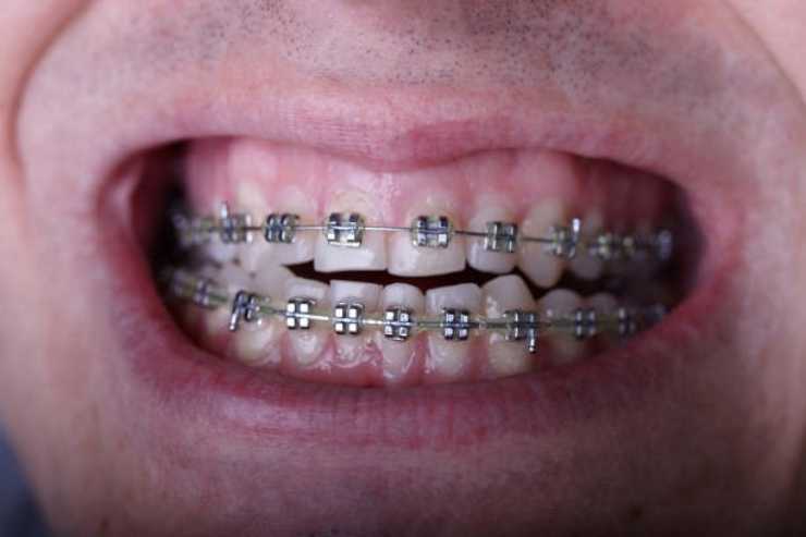 اعوجاج الاسنان، دخول الأسنان للداخل