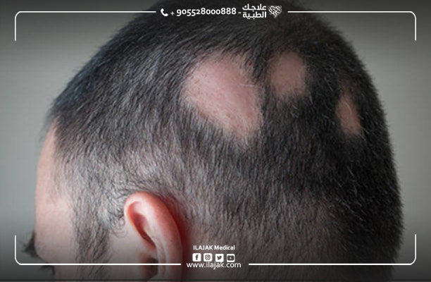 alopecie areata