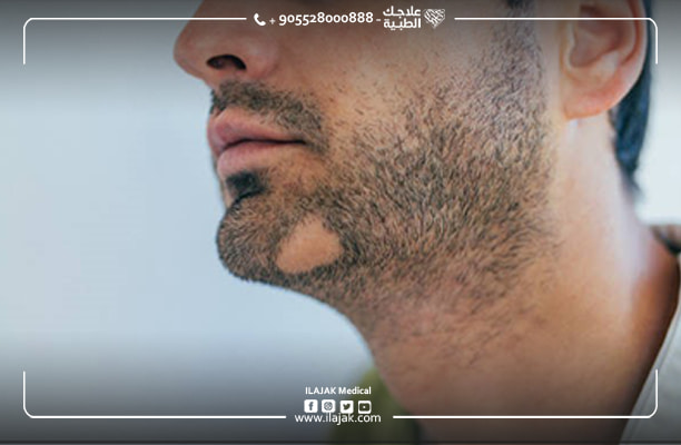 pelade barbe