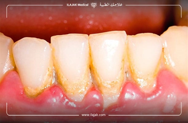 La Gingivite Quel Traitement Disponible Ilajak M dical La Gingivite Quel Traitement Disponible Ilajak M dical