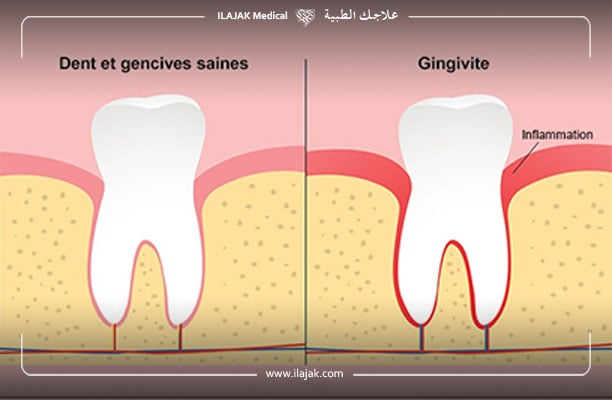 qu est ce qu une gingivite