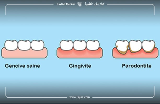 parodontite gingivite